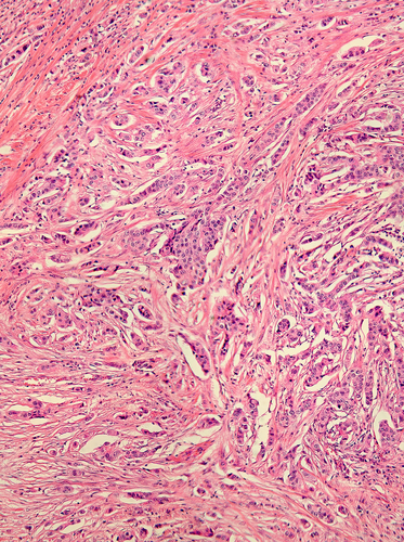 Genetic Mutations Found in Lung Adenocarcinoma May Open Treatments for Patients