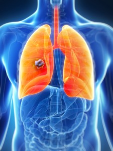 lung cancer mRNAs