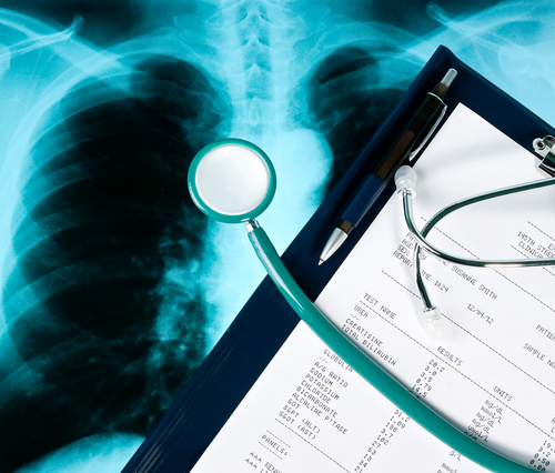 Veracyte To Use Lung Cancer Test To Enter Pulmonology Market By 2015