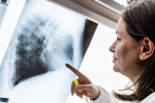 lung cancer screening and medicare