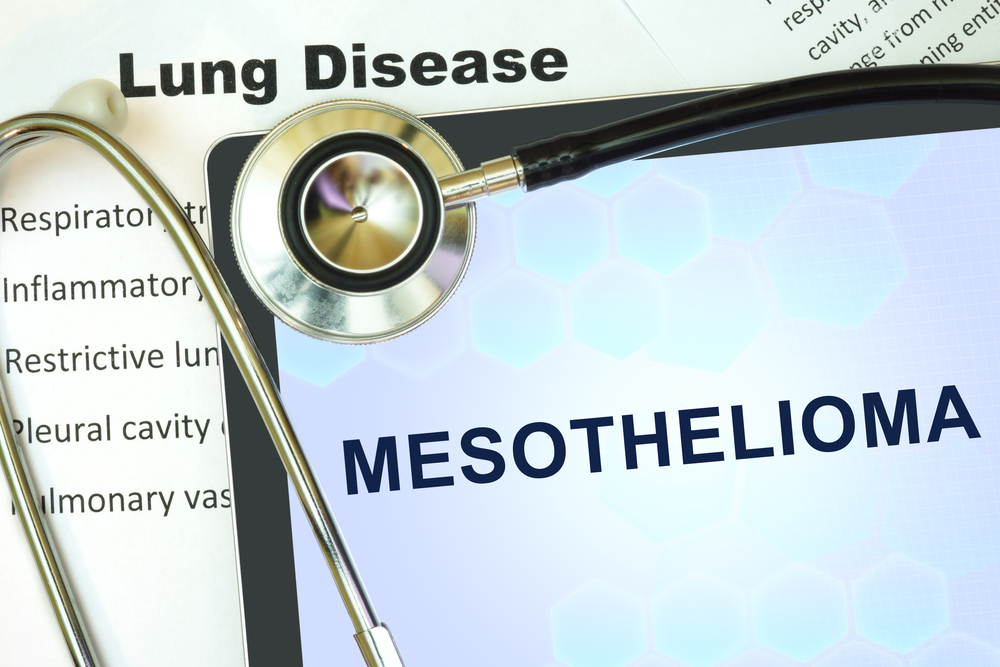 Mesothelioma Afflicting Younger People And Women In Southern Nevada Attributable To Environmental Asbestos