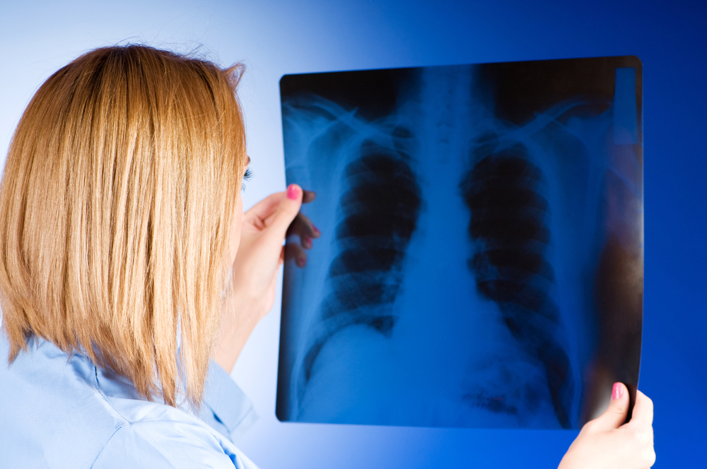 Lung Cancer Identified as Leading Female Mortality Cause in Developed Countries