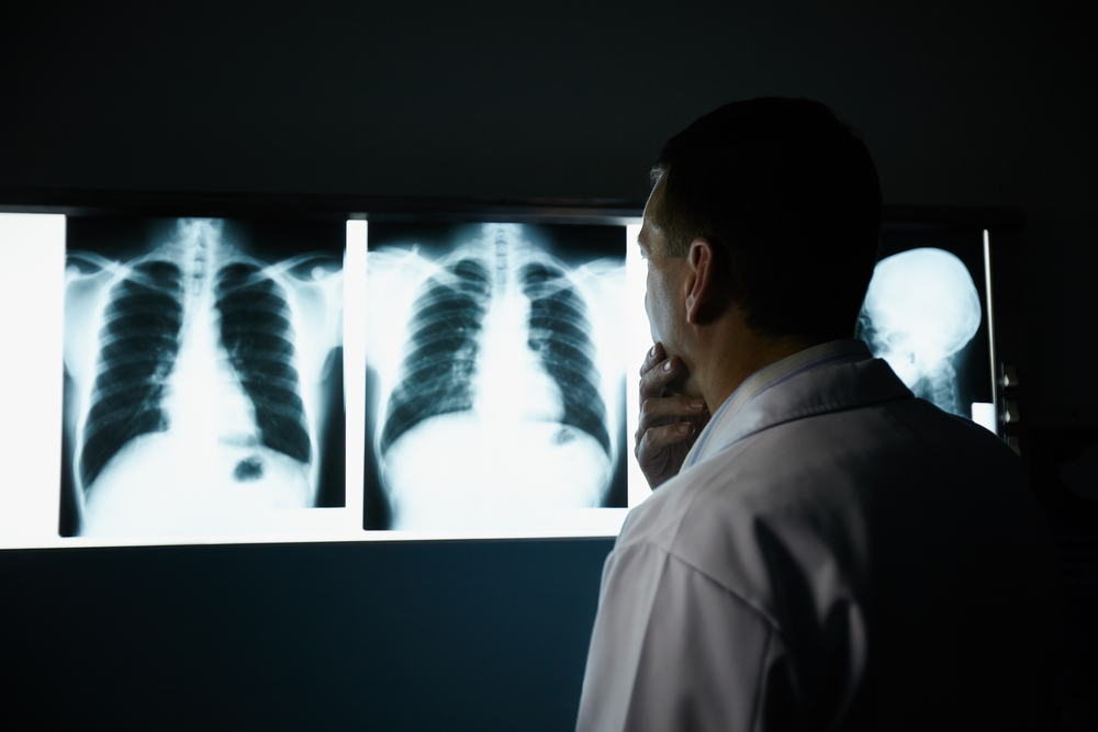 Cancer Survivors Should Not Be Excluded in Advanced Stage Lung Cancer Trials, According to New Study