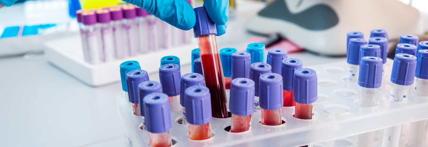 Blood Test at Lung Cancer Diagnosis Shortens Time to Treatment Decision