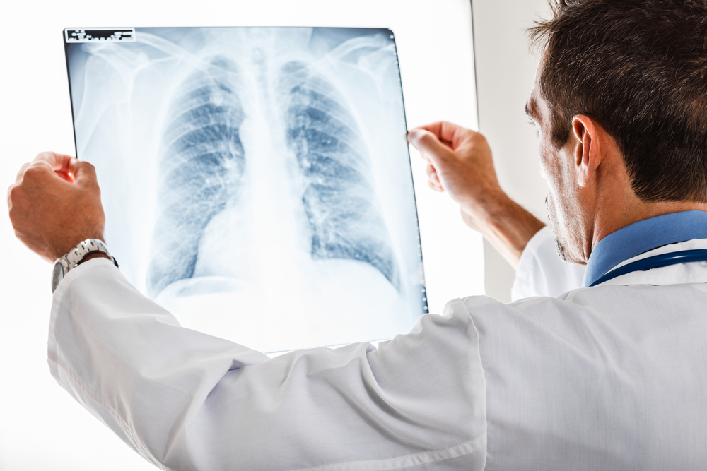 lung-cancer-can-go-undetected-in-kidney-cancer-patients