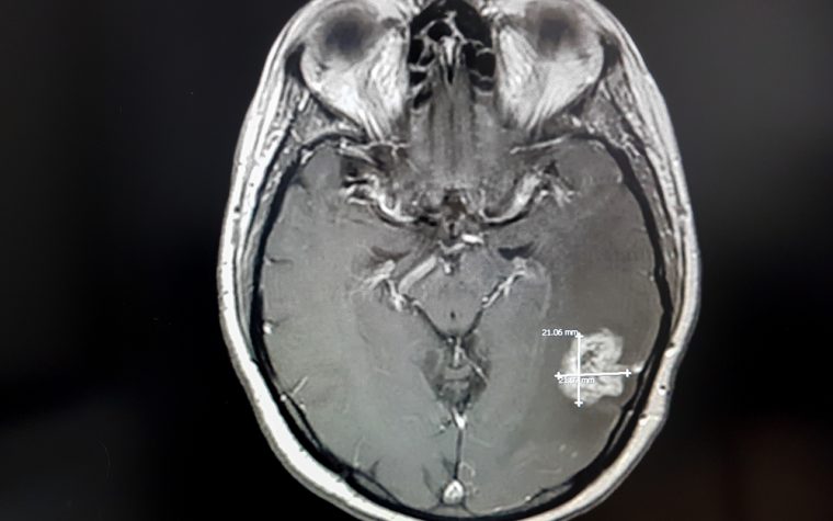 70% of Patients with Brain Cancer Originating in the Lungs Responded to Tagrisso, Trial Shows